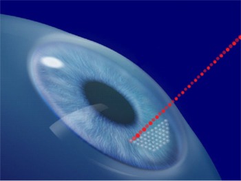 Click to enlarge photo of IntraLase All-Laser No-Blade LASIK Surgery Flap Creation